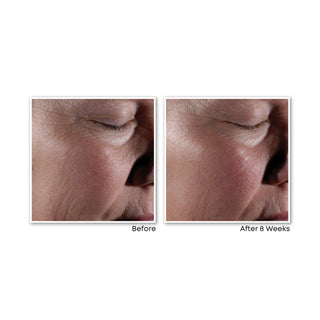 RETINOL CORREXION® MAX Wrinkle Resurfacing System